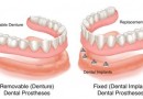tipuri de implanturi dentare