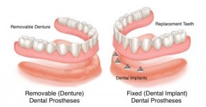 tipuri de implanturi dentare