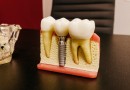 implant dentar in Bucuresti