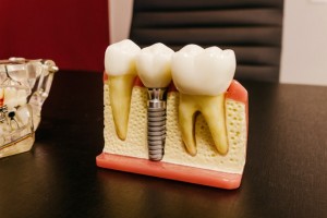 implant dentar in Bucuresti