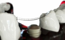 implant dentar în Bucuresti